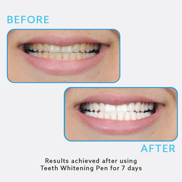 teeth whitening products reviews